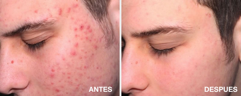 acne-antes-despues